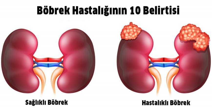 BÖBREK HASTALIĞININ  BELİRTİLERİ